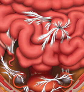Graphic depiction of post-surgery abdominal adhesions